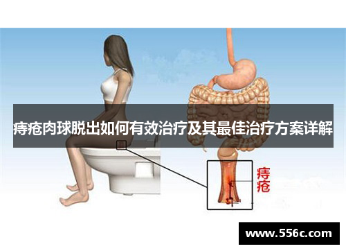 痔疮肉球脱出如何有效治疗及其最佳治疗方案详解